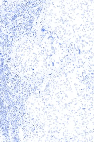 iCura Histology View Lung Adenocarcinoma Nucleus webp file