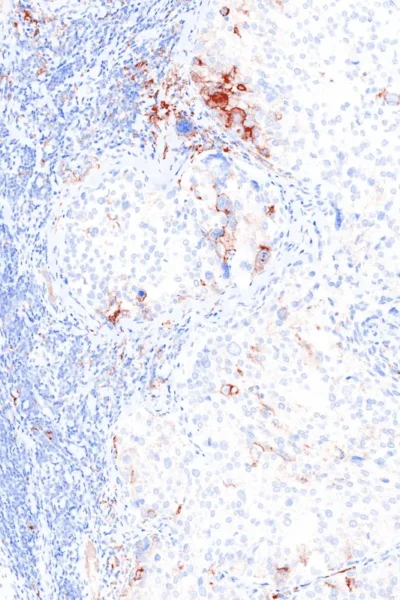 iCura Histology View Lung Adenocarcinoma PD-L1 webp file